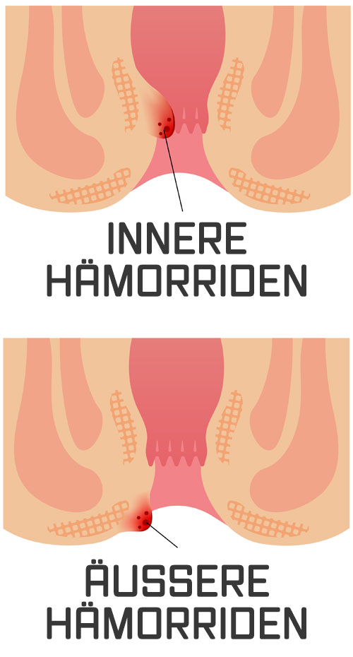Als Erste-Hilfe-Maßnahme bei starken Beschwerden zu Hause: Ein Sitzbad in kühlem Wasser mit einem Zusatz einer Eichenrindenabkochung aus der Apotheke bringt Erleichterung.