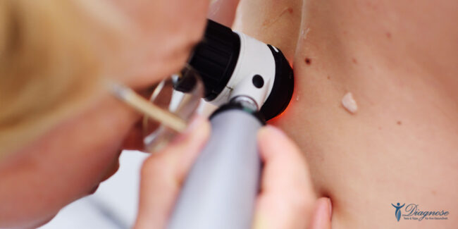 Etwa 15 Prozent der Deutschen haben Warzen. Diese hässlichen, aber gutartigen Hautveränderungen werden durch Viren verursacht und verbreiten sich besonders bei Kindern und Jugendlichen. Mit rezeptfreien Tinkturen oder Pflastern aus der Apotheke können Warzen aufgelöst werden und fallen narbenfrei ab.