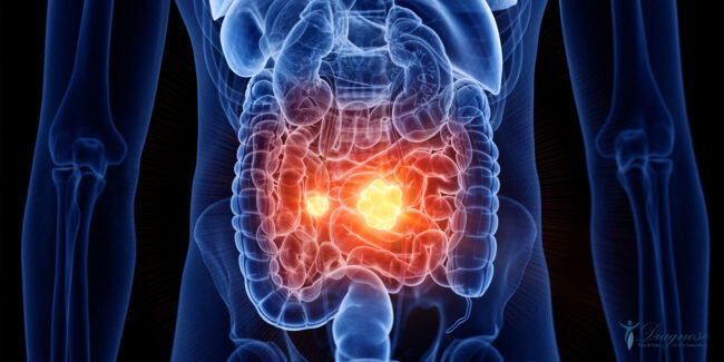 Nicht ohne Grund hatte jeder ägyptische Pharao einen speziellen Leibarzt, den „Hüter des Dickdarms“. Er war der König der Leibärzte